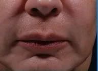 Bellafill for smile lines, five years after treatment, after