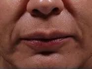 Bellafill for smile lines, five years after treatment, before
