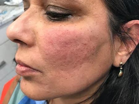 Bellafill for acne scars, cheek, after