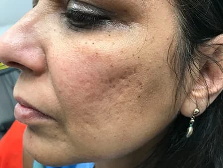 Bellafill for acne scars, cheek, before