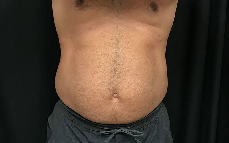 Body contouring (home page), after