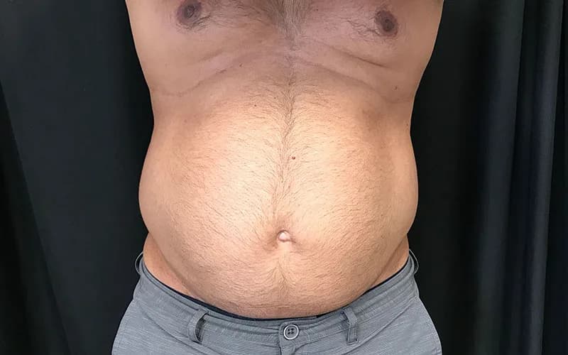Body contouring (home page), before