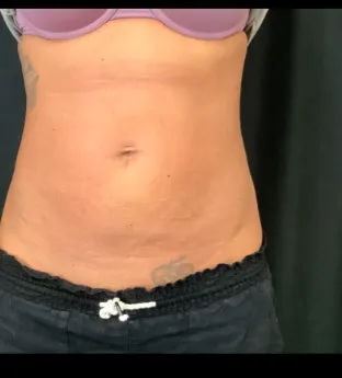 BodyTite with VASER liposuction, abdomen, one month after treatment, after