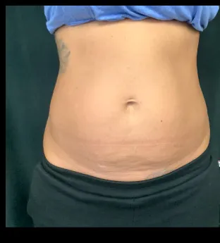 BodyTite with VASER liposuction, abdomen, one month after treatment, before