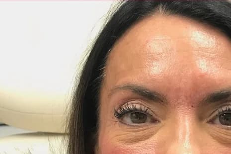 Botox, forehead and frown lines, after
