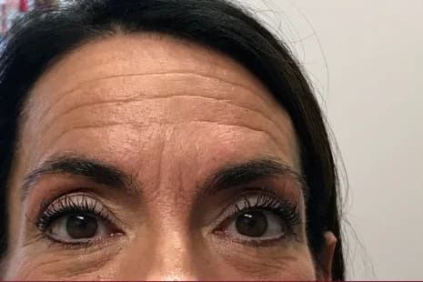 Botox, forehead and frown lines, before