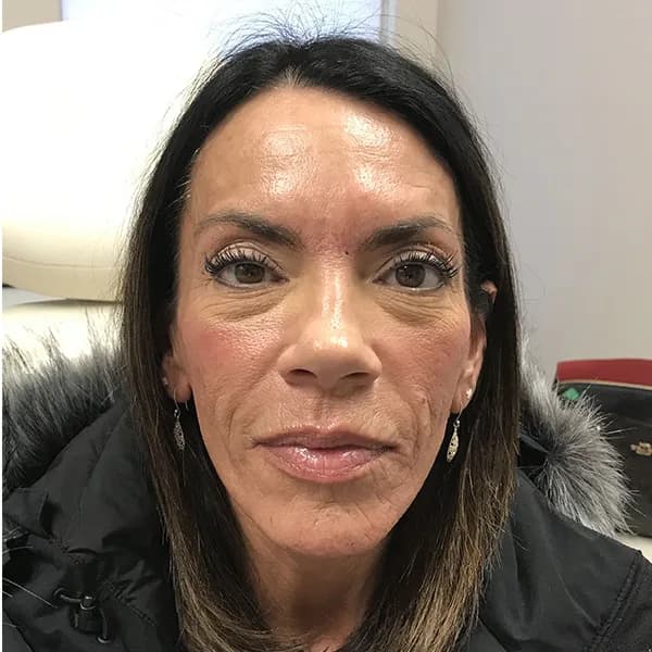 Botox, full face, after