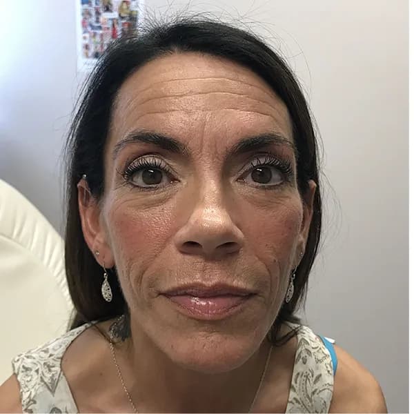 Botox, full face, before