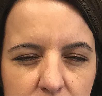 Botox for frown lines, patient attempting to frown in the after photo, after