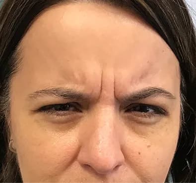 Botox for frown lines, patient attempting to frown in the after photo, before