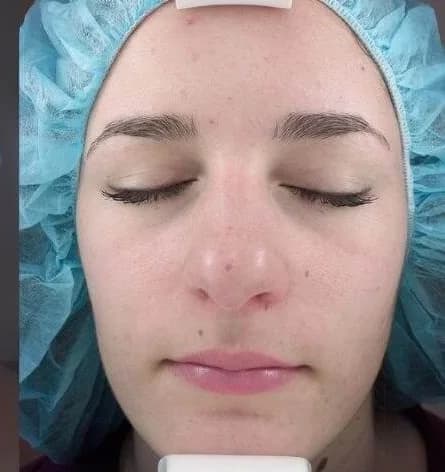 Chemical peel for active acne, after