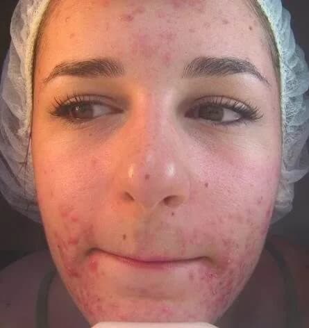 Chemical peel for active acne, before