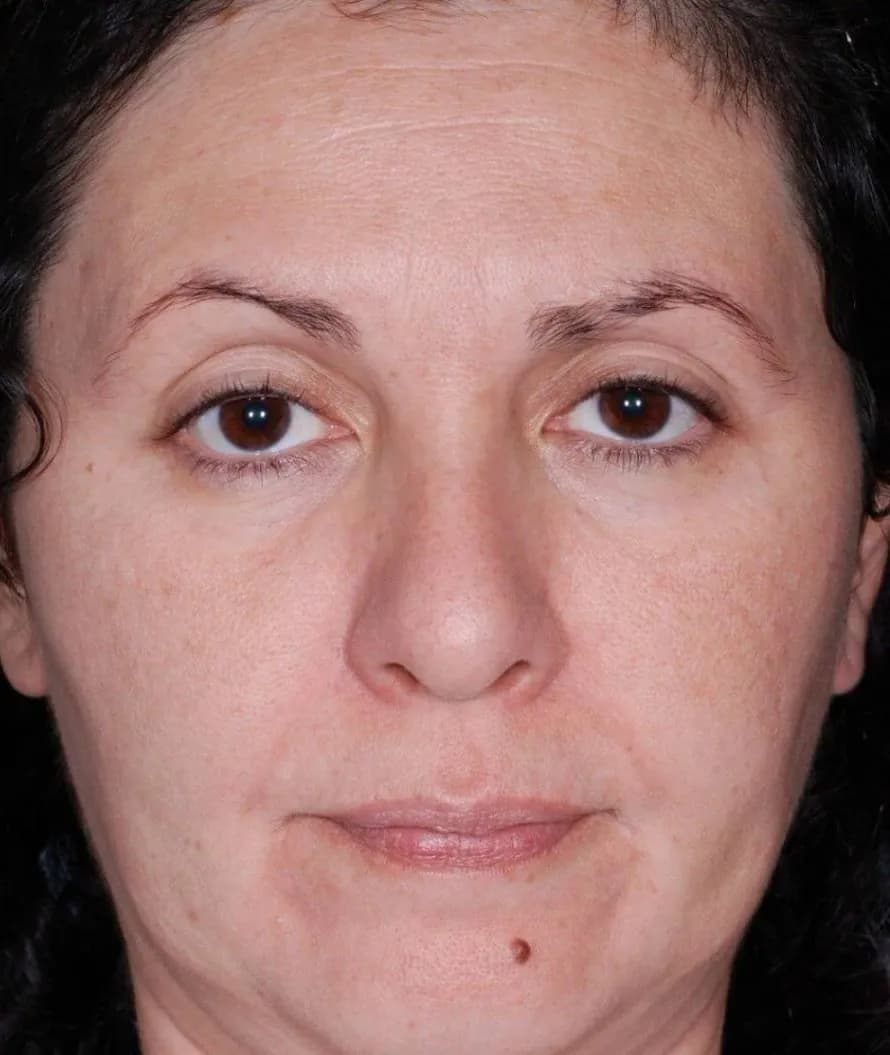 Chemical peel, full face, after