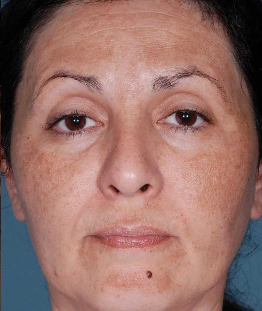 Chemical peel, full face, before