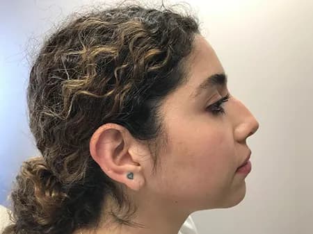 Chin enhancement with filler, profile view, after