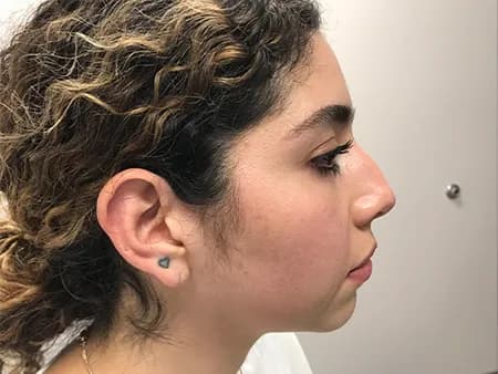 Chin enhancement with filler, profile view, before