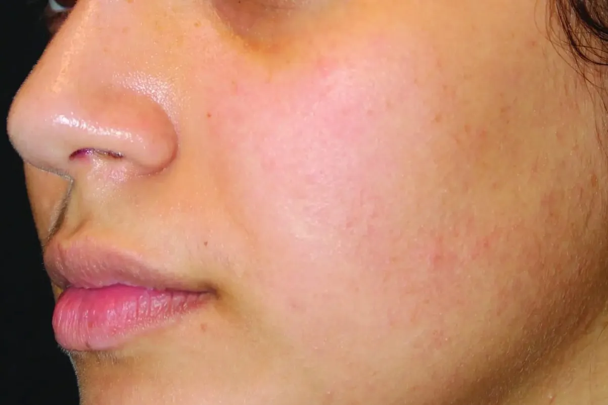 Clear + Brilliant, cheek redness and texture, after