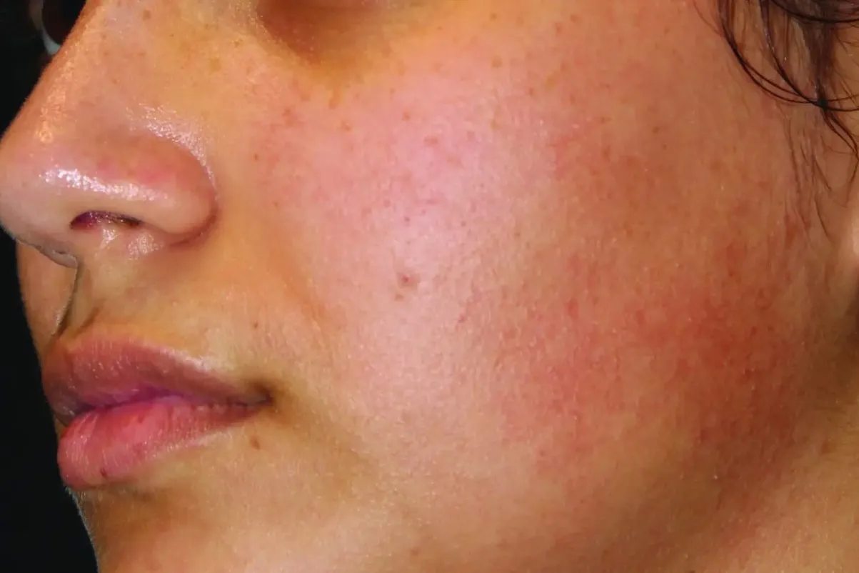Clear + Brilliant, cheek redness and texture, before