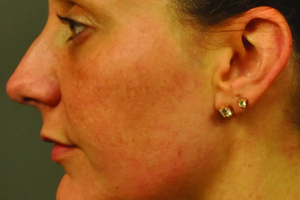 Clear + Brilliant, pigmentation, side profile, after