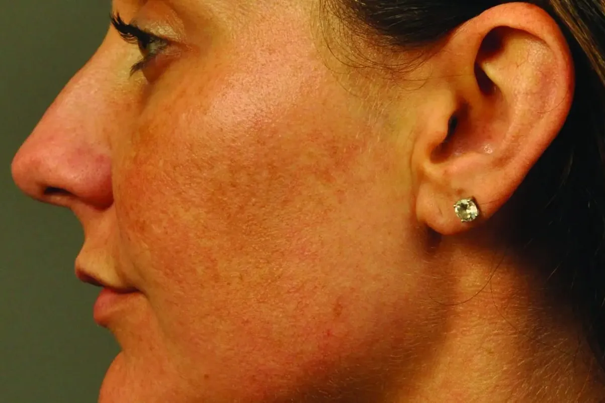 Clear + Brilliant, pigmentation, side profile, before