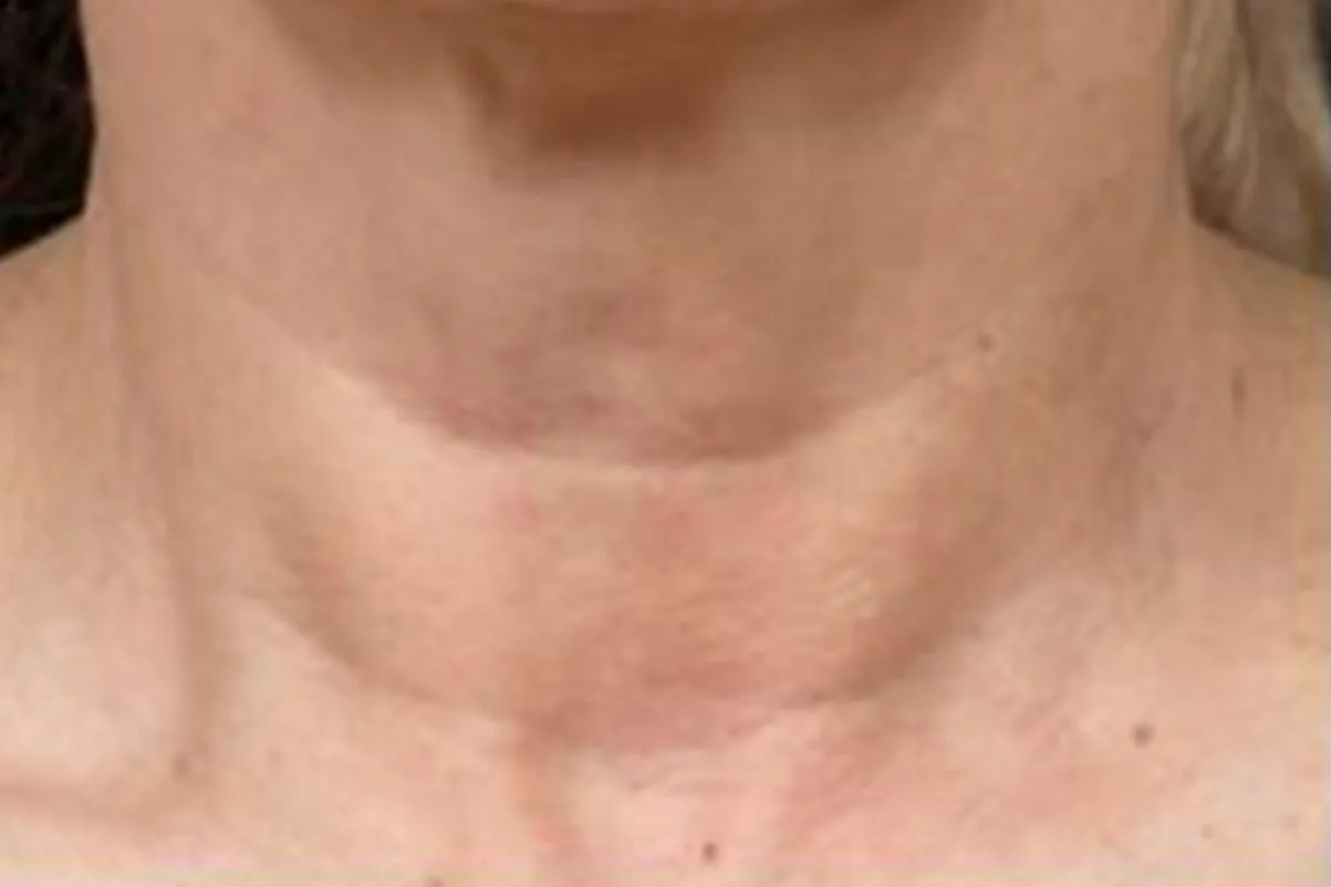 Clear + Brilliant, neck texture, after