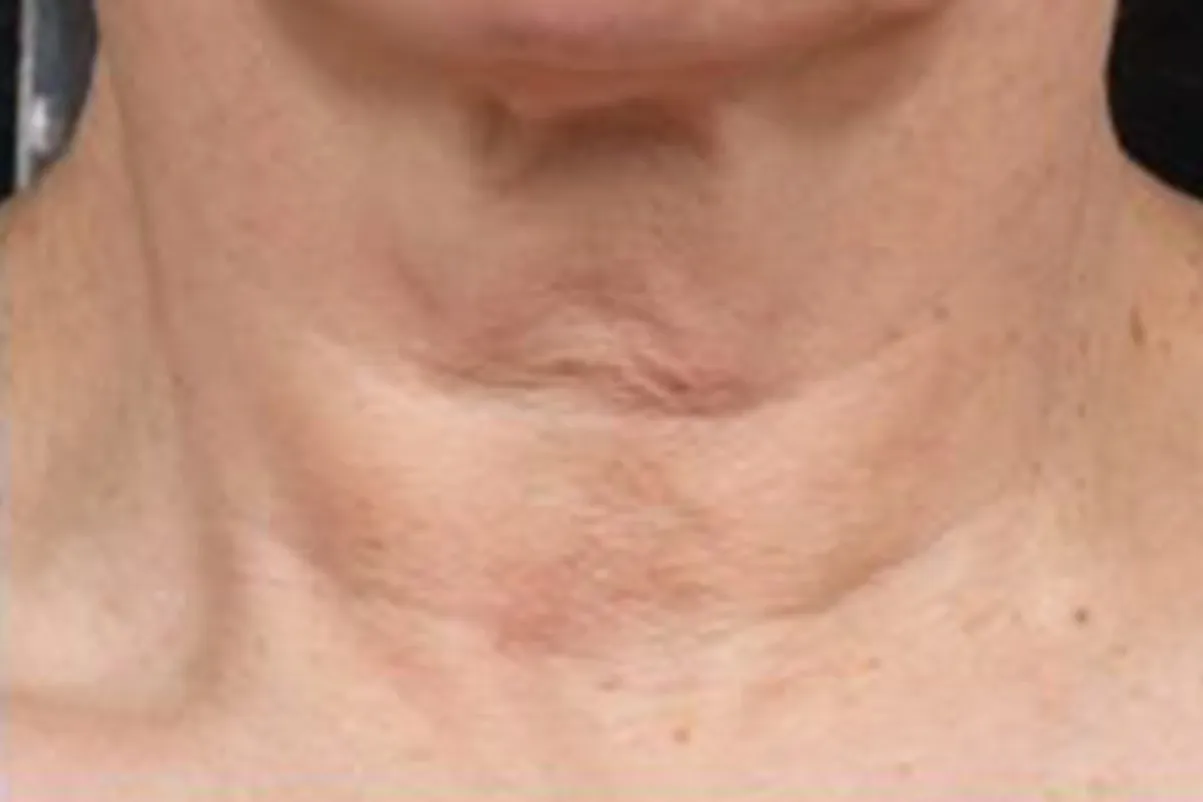 Clear + Brilliant, neck texture, before