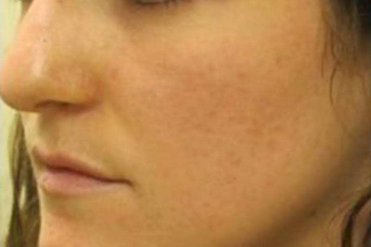 Clear + Brilliant for acne scarring, oblique view, after