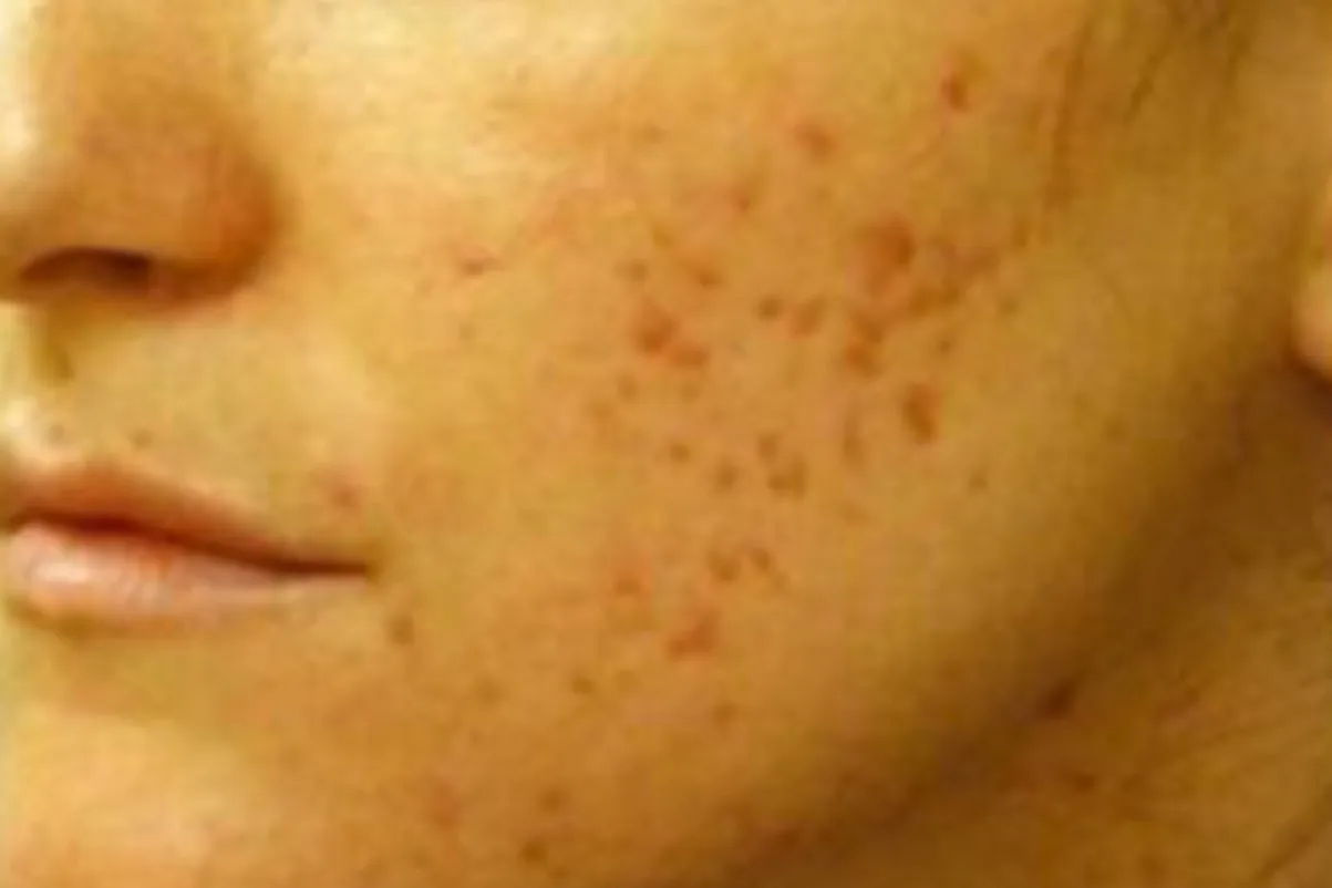 Clear + Brilliant for acne scarring, oblique view, before