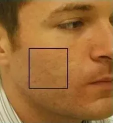 Clear + Brilliant, male acne scarring, after