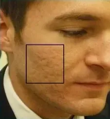Clear + Brilliant, male acne scarring, before