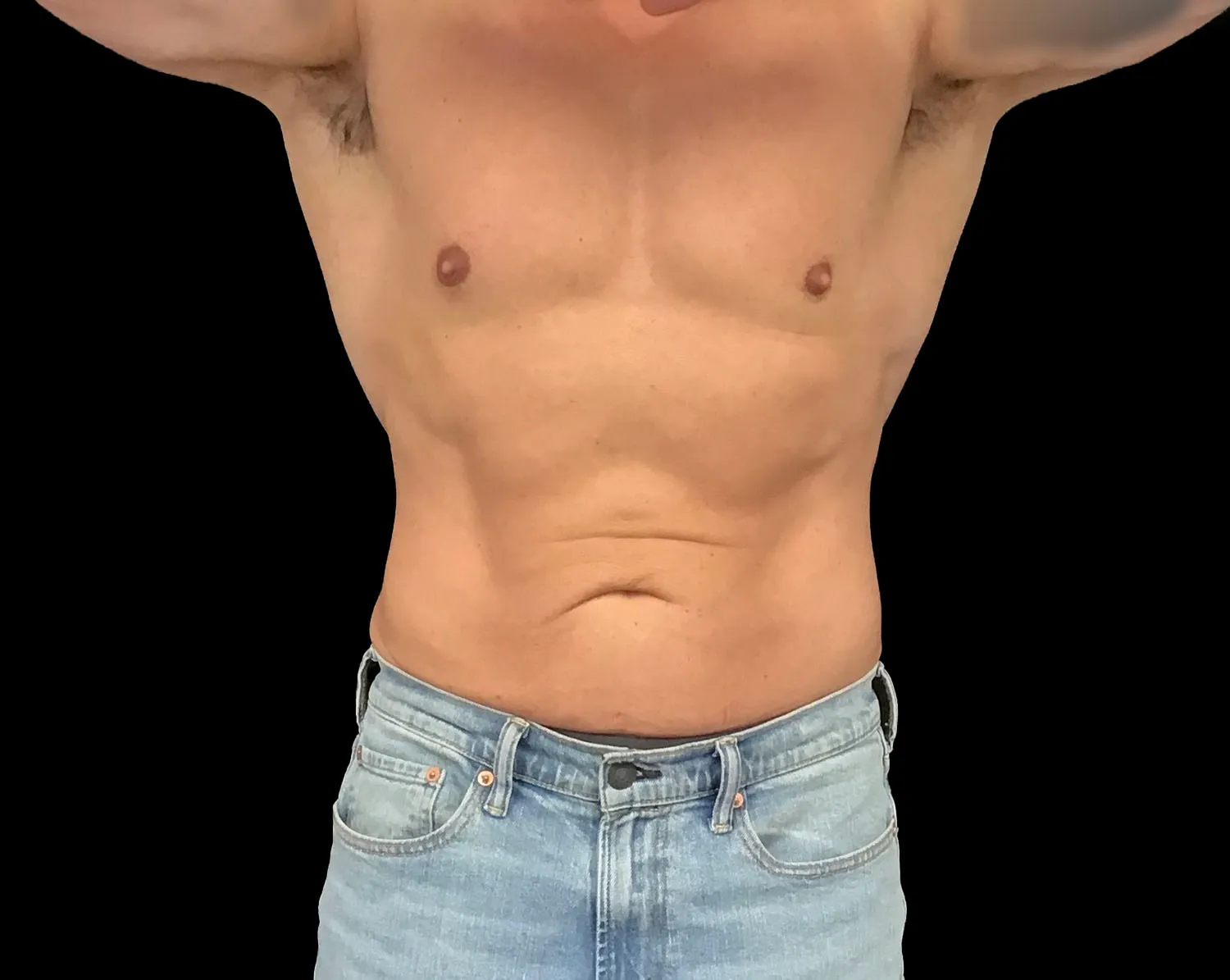 CoolSculpting Elite, abdomen, after