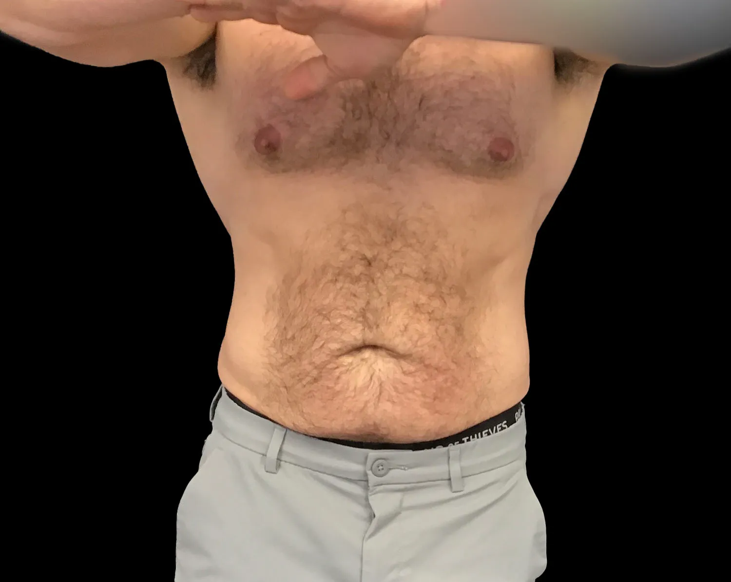CoolSculpting Elite, abdomen, before