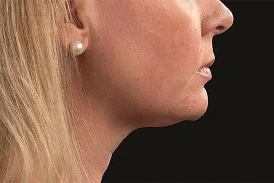 CoolSculpting Elite, chin and neck, after