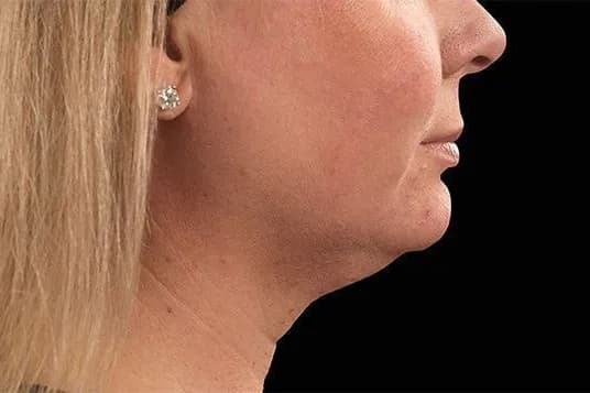 CoolSculpting Elite, chin and neck, before