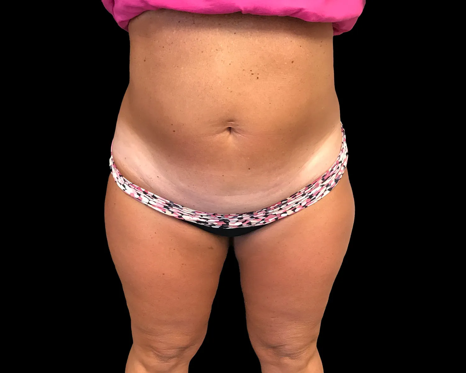 CoolSculpting Elite, abdomen, after