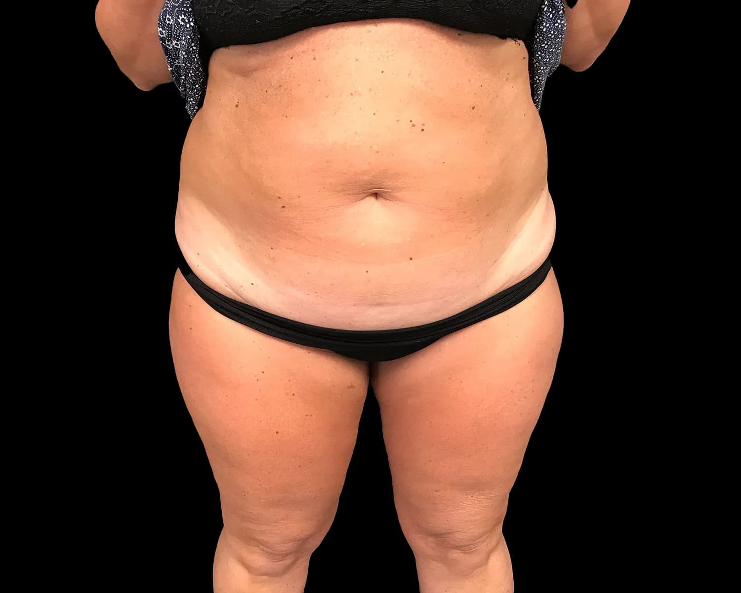 CoolSculpting Elite, abdomen, before