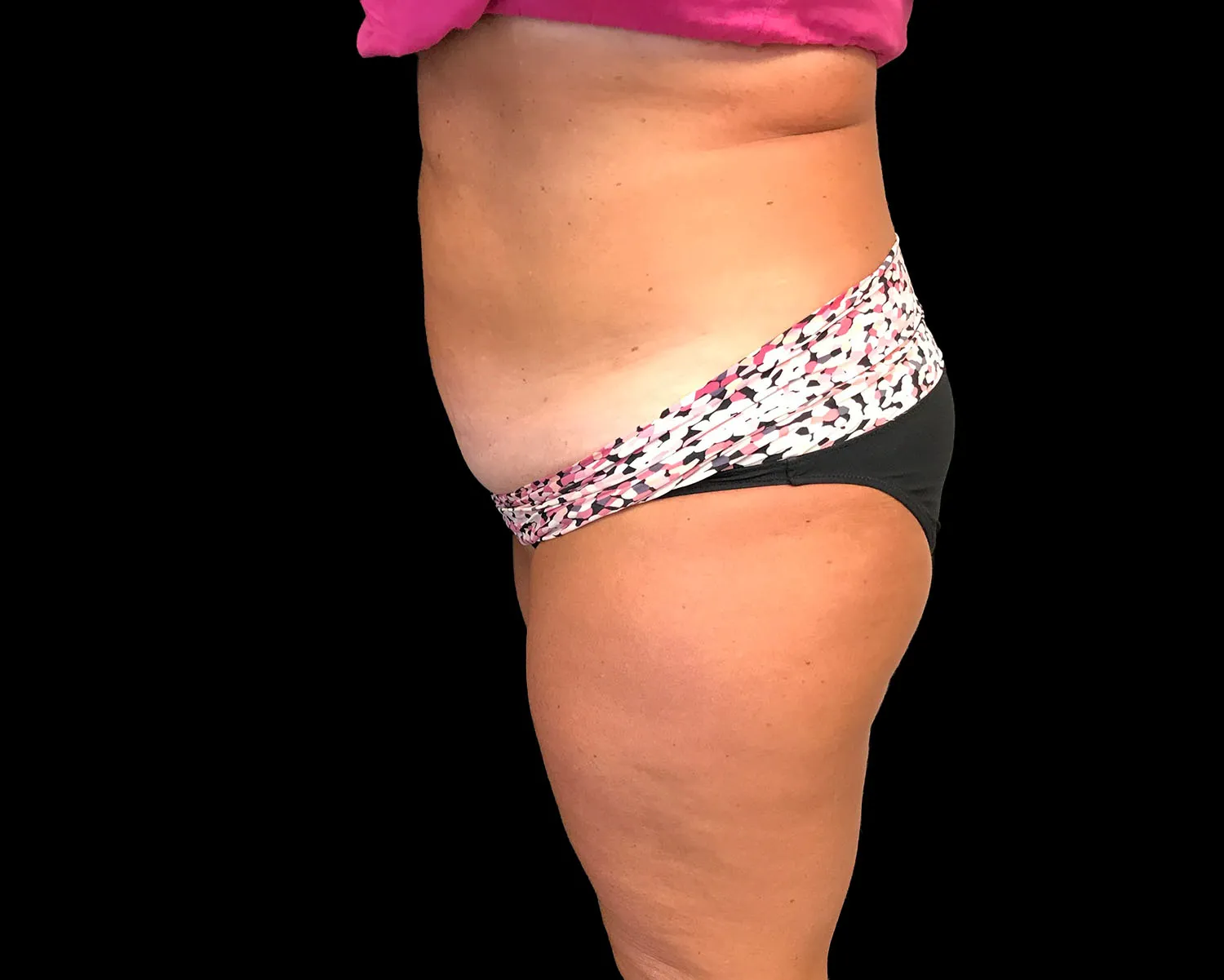 CoolSculpting Elite, abdomen and flanks, side view, after