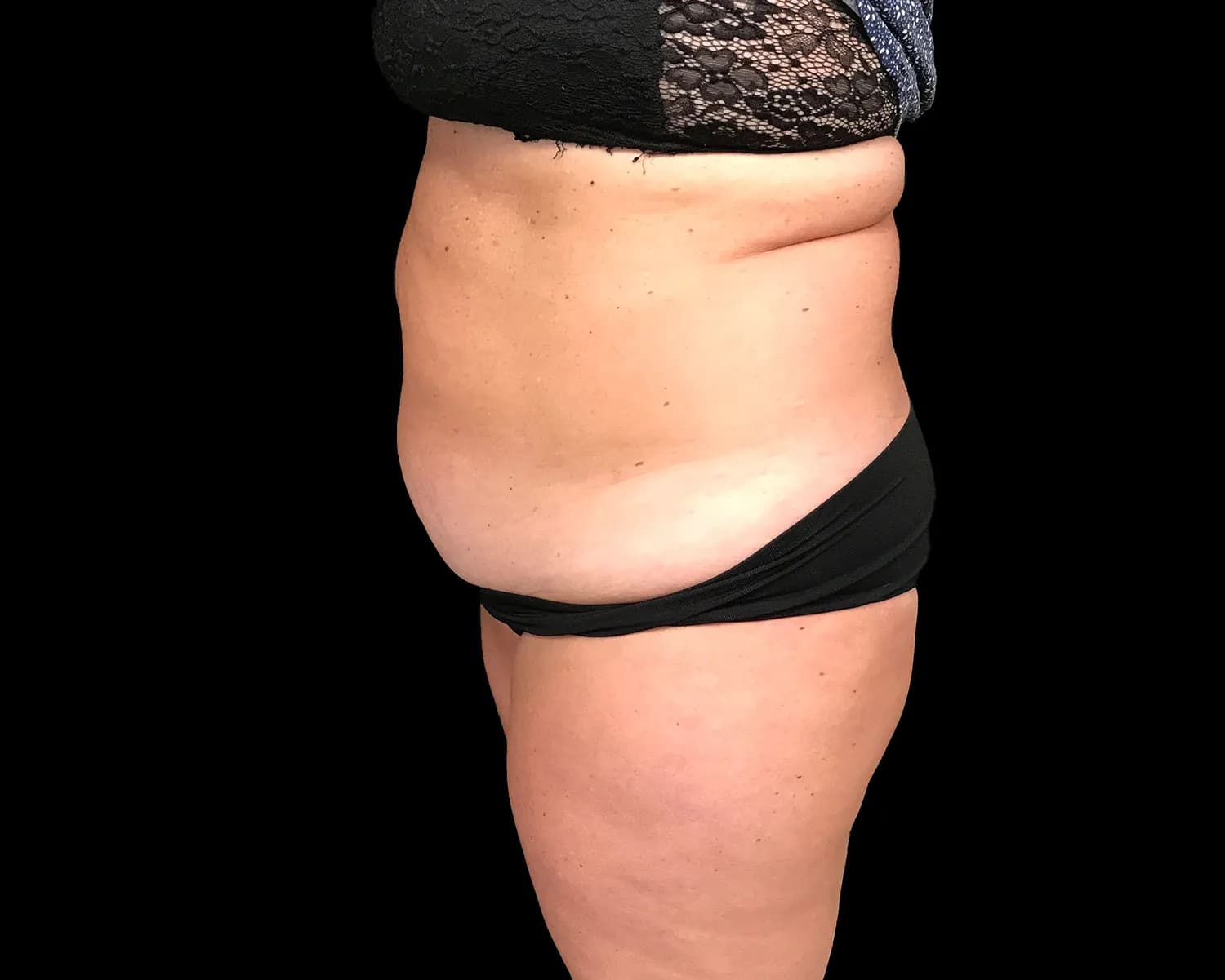 CoolSculpting Elite, abdomen and flanks, side view, before