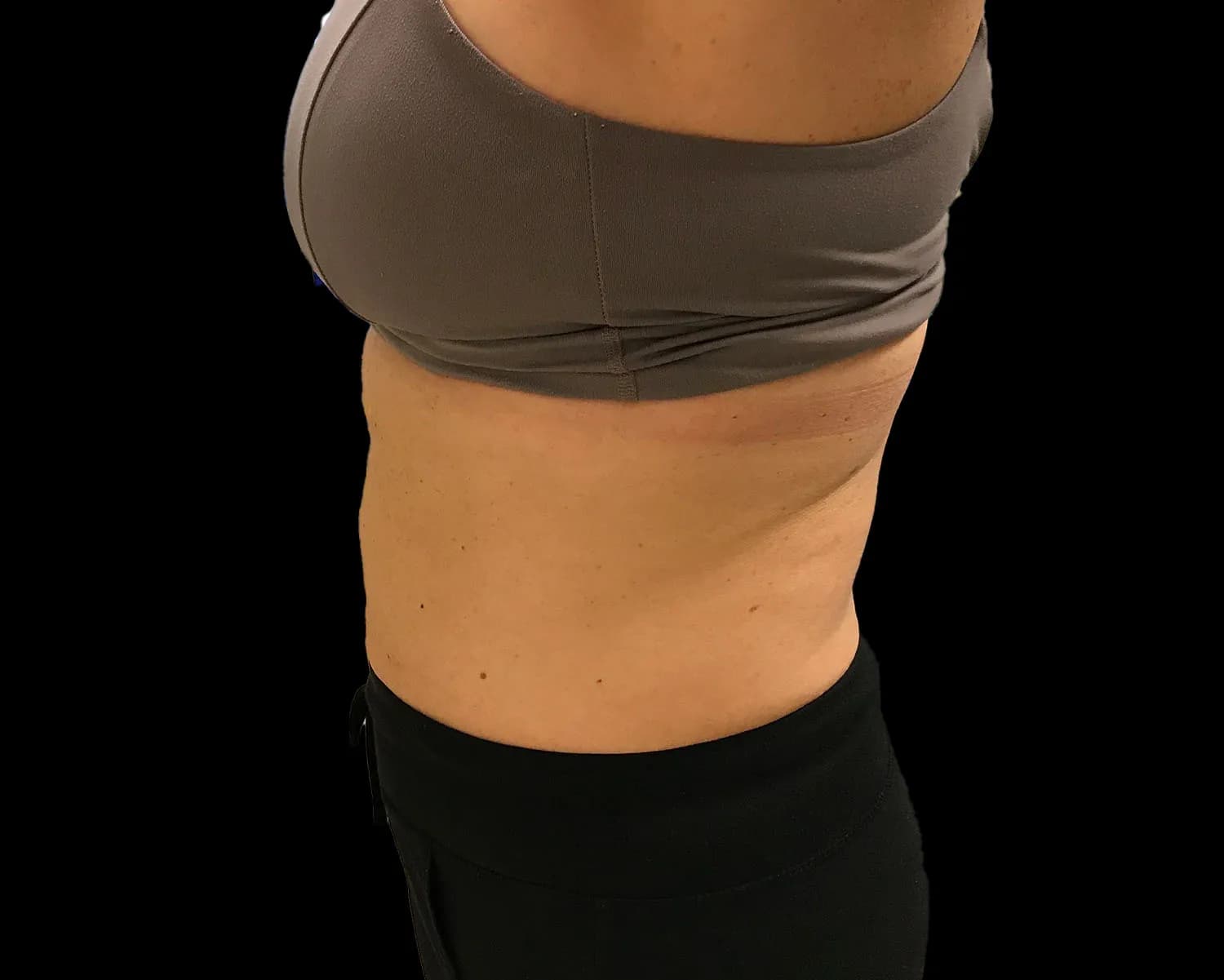 CoolSculpting Elite, back and flanks, side view, after