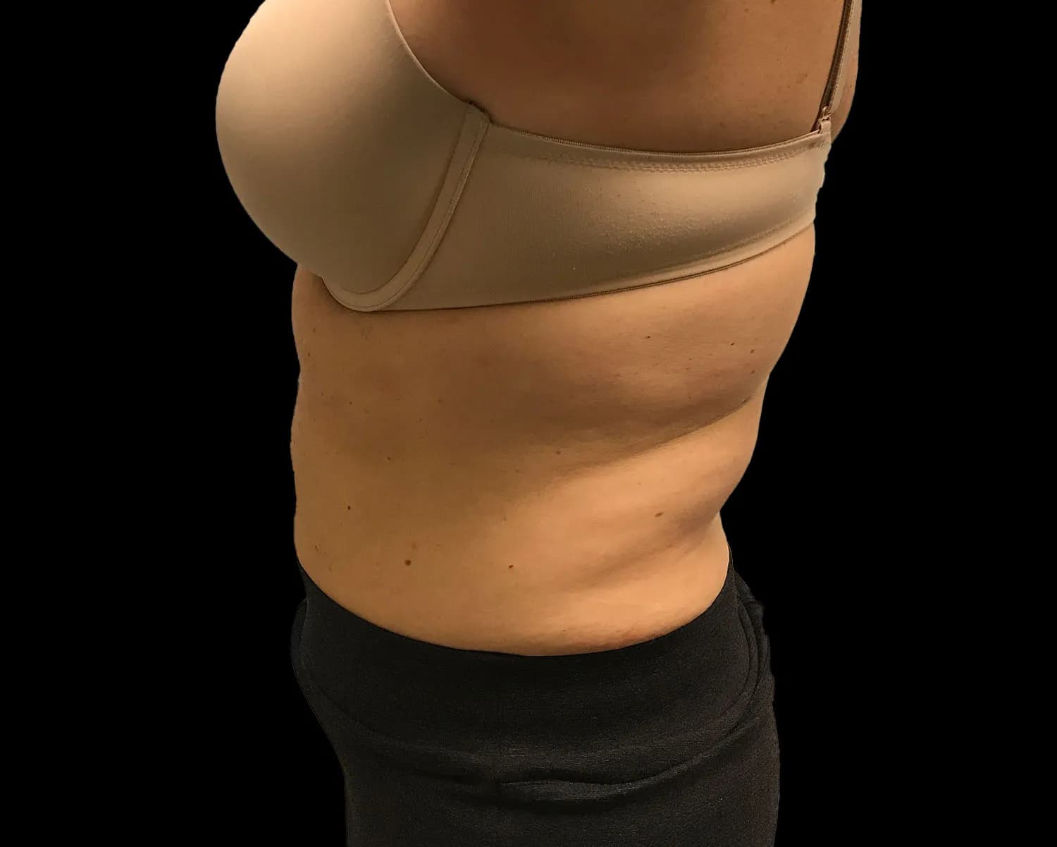 CoolSculpting Elite, back and flanks, side view, before