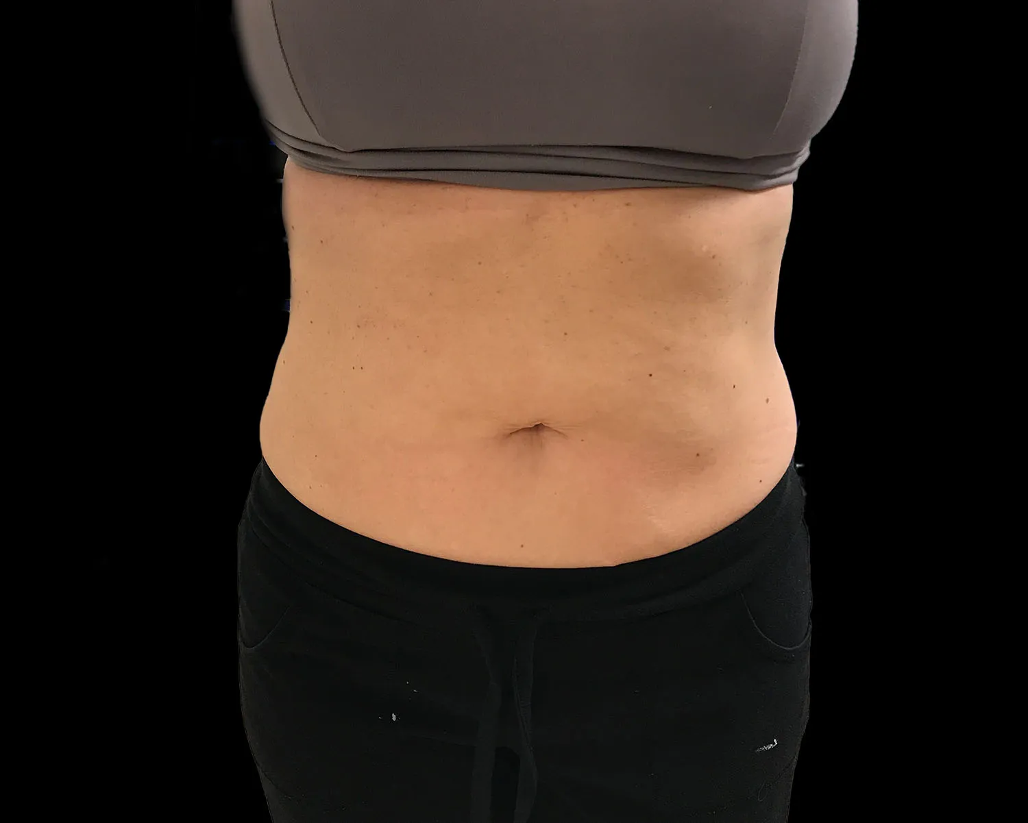 CoolSculpting Elite, abdomen, after