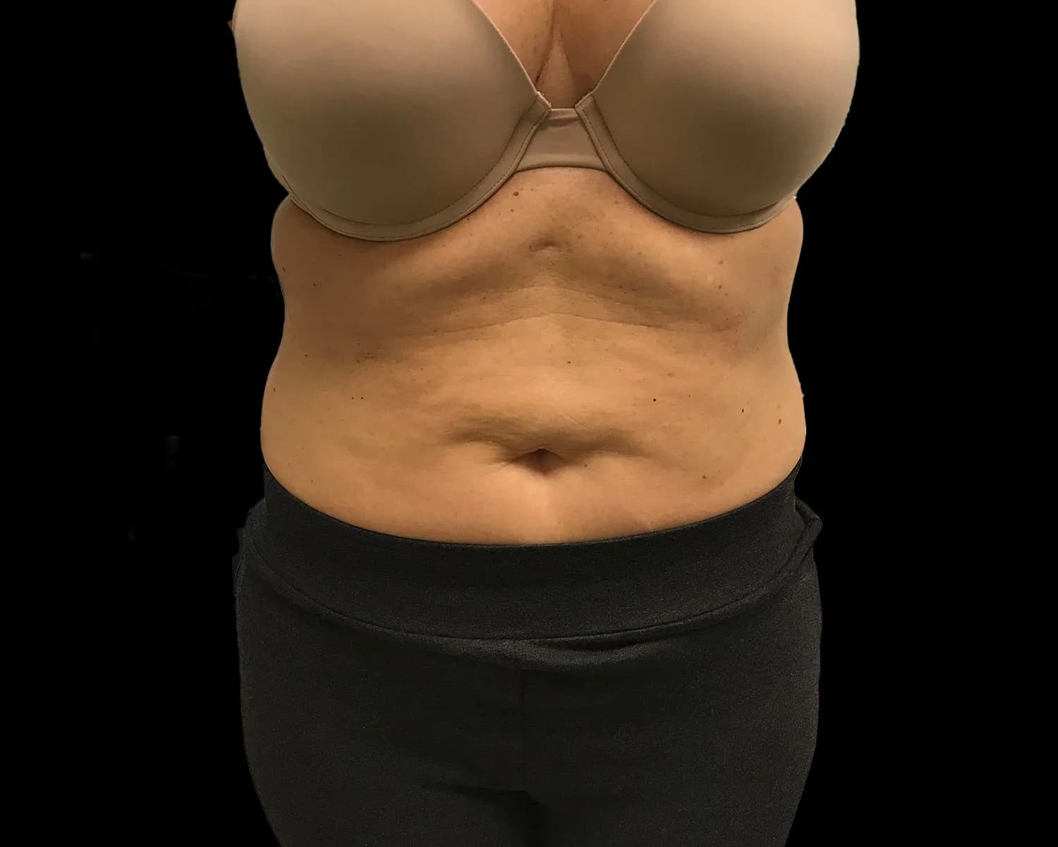 CoolSculpting Elite, abdomen, before