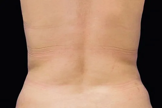 CoolSculpting Elite, back and flanks, after