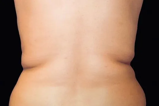 CoolSculpting Elite, back and flanks, before