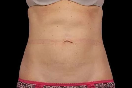 CoolSculpting Elite, abdomen, after