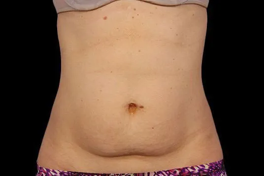 CoolSculpting Elite, abdomen, before