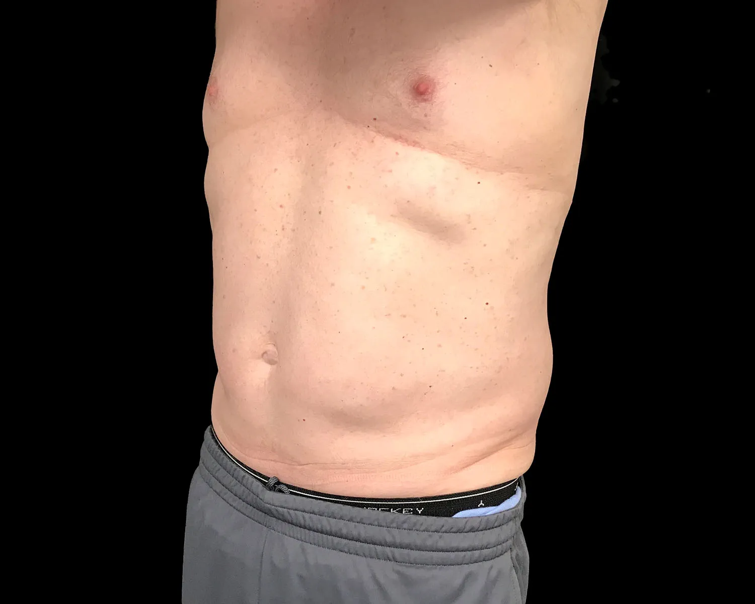 CoolSculpting Elite, abdomen, oblique view, after