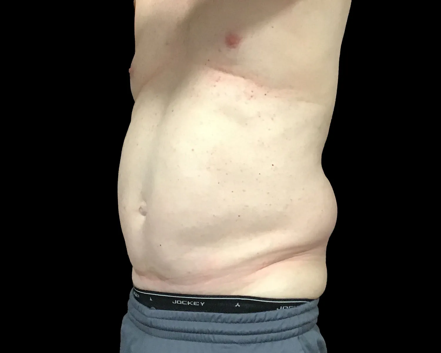 CoolSculpting Elite, abdomen, oblique view, before