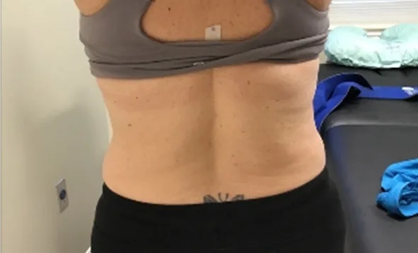 CoolSculpting Elite, back and bra line, after