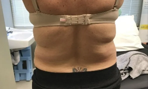 CoolSculpting Elite, back and bra line, before